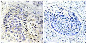 Immunohistochemical analysis of paraffin-embedded human lung cancer using Anti-ACOT2 Antibody 1:100 (4°C overnight). The right hand panel represents a negative control, where the antibody was pre-incubated with the immunising peptide