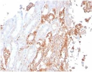 Immunohistochemical analysis of formalin-fixed, paraffin-embedded human renal cell carcinoma tissue using Anti-alpha II Spectrin Antibody [SPTAN1/3506]