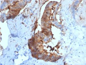 Immunohistochemical analysis of formalin-fixed, paraffin-embedded human renal cell carcinoma using Anti-Cathepsin D Antibody [CTSD/2781]