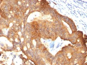 Immunohistochemical analysis of formalin-fixed, paraffin-embedded colon carcinoma using Anti-Cytokeratin 8 Antibody [B22.1]