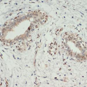 Immunohistochemistry analysis of paraffin-embedded human breast cancer tissue using Anti-KDM6A/UTX Antibody (A12215) at a dilution of 1:200 (40X lens). Perform microwave antigen retrieval with 10 mM PBS buffer pH 7.2 before commencing with IHC staining protocol