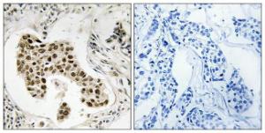 Immunohistochemical analysis of paraffin-embedded human breast carcinoma using Anti-PMS2 Antibody. The right hand panel represents a negative control, where the antibody was pre-incubated with the immunising peptide.