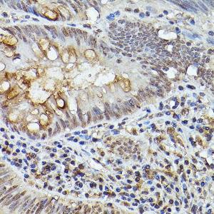 Immunohistochemistry analysis of paraffin-embedded human colon carcinoma tissue using Anti-TASL Antibody (A308062) at a dilution of 1:50 (40X lens). Perform high pressure antigen retrieval with 10 mM citrate buffer pH 6.0 before commencing with IHC staining protocol