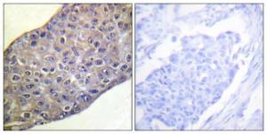 Immunohistochemical analysis of paraffin-embedded human breast carcinoma tissue using Anti-RhoA Antibody. The right hand panel represents a negative control, where the antibody was pre-incubated with the immunising peptide.