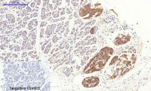 Immunohistochemical analysis of paraffin-embedded human stomach cancer tissue using Anti-RhoA Antibody at 1:200 (4°C overnight). Negative control was secondary antibody only.