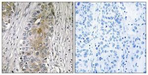 Immunohistochemical analysis of paraffin-embedded human lung carcinoma using Anti-SAA4 Antibody The right hand panel represents a negative control, where the antibody was pre-incubated with the immunising peptide