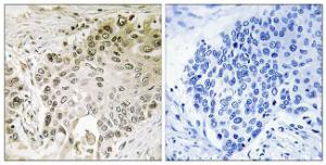 Immunohistochemical analysis of paraffin-embedded human lung carcinoma using Anti-RFX2 Antibody The right hand panel represents a negative control, where the antibody was pre-incubated with the immunising peptide