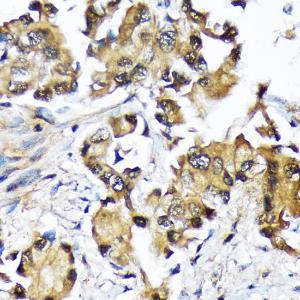 Immunohistochemistry analysis of paraffin-embedded human lung cancer using Anti-Ube2N / Ubc13 Antibody [ARC1495] (A306899) at a dilution of 1:100 (40x lens). Perform microwave antigen retrieval with 10 mM Tris/EDTA buffer pH 9.0 before commencing with IHC staining protocol.