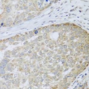 Immunohistochemistry of paraffin-embedded human liver cancer using Anti-ANAPC10 Antibody (A8330) at dilution of 1:100 (40X lens)