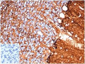 Immunohistochemical analysis of formalin-fixed, paraffin-embedded human brain tissue using Anti-S100 beta Antibody [S100B/4138] at 2µg/ml. Inset: PBS instead of the primary antibody. Secondary antibody negative control.