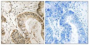 Immunohistochemical analysis of paraffin-embedded human colon carcinoma tissue using Anti-RGS1 Antibody The right hand panel represents a negative control, where the antibody was pre-incubated with the immunising peptide