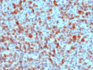 Immunohistochemical analysis of formalin-fixed, paraffin-embedded human melanoma using Anti-S100 beta Antibody