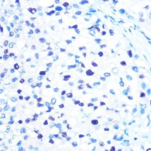 Immunohistochemistry analysis of paraffin-embedded human liver cancer using Anti-MCM3 Antibody [ARC0607] (A306905) at a dilution of 1:100 (40x lens) Perform microwave antigen retrieval with 10 mM PBS buffer pH 72 before commencing with IHC staining protocol