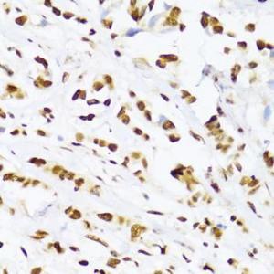 Immunohistochemistry analysis of paraffin-embedded human breast cancer tissue using Anti-UAP56 Antibody (A12241) at a dilution of 1:100 (40x lens). Perform microwave antigen retrieval with 10 mM PBS buffer pH 7.2 before commencing with IHC staining protocol.