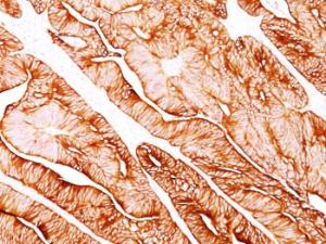 Immunohistochemical analysis of formalin-fixed, paraffin-embedded human colon carcinoma using Anti-Cytokeratin 8 Antibody [H1]