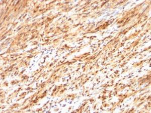 Immunohistochemical analysis of formalin-fixed, paraffin-embedded human schwanoma using Anti-S100 beta Antibody