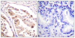 Immunohistochemical analysis of paraffin-embedded human lung carcinoma tissue using Anti-RFA2 Antibody. The right hand panel represents a negative control, where the antibody was pre-incubated with the immunising peptide