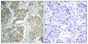 Immunohistochemical analysis of paraffin-embedded human breast carcinoma using Anti-VEGFR2 (phospho Tyr1214) Antibody The right hand panel represents a negative control, where the antibody was pre-incubated with the immunising peptide