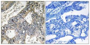 Immunohistochemical analysis of paraffin-embedded human colon carcinoma tissue using Anti-GUF1 Antibody. The right hand panel represents a negative control, where the antibody was pre-incubated with the immunising peptide