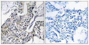 Immunohistochemical analysis of paraffin-embedded human breast carcinoma using Anti-GBP4 Antibody. The right hand panel represents a negative control, where the antibody was pre-incubated with the immunising peptide