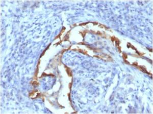 Immunohistochemical analysis of formalin-fixed, paraffin-embedded human lung carcinoma using Anti-Cytokeratin 8 Antibody [SPM538]