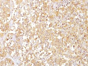 Immunohistochemical analysis of formalin-fixed, paraffin-embedded human melanoma using Anti-Melanoma gp100 Antibody [SPM142]