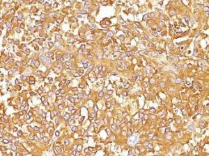 Immunohistochemical analysis of formalin-fixed, paraffin-embedded human melanoma using Anti-Melanoma gp100 Antibody [SPM142]