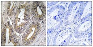 Immunohistochemical analysis of paraffin-embedded human colon carcinoma using Anti-CST2 Antibody. The right hand panel represents a negative control, where the antibody was pre-incubated with the immunising peptide.