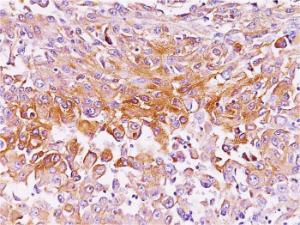 Immunohistochemical analysis of formalin-fixed, paraffin-embedded human melanoma using Anti-Melanoma gp100 Antibody [NKI-beteb]