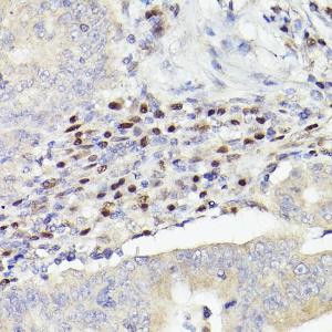 Immunohistochemistry analysis of paraffin-embedded human colon carcinoma tissue using Anti-MEF2A + MEF2C Antibody [ARC2661] (A308083) at a dilution of 1:100 (40X lens). Perform high pressure antigen retrieval with 10 mM citrate buffer pH 6.0 before commencing with IHC staining protocol