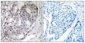 Immunohistochemical analysis of paraffin-embedded human breast carcinoma using Anti-DARPP-32 (phospho Thr75) Antibody. The right hand panel represents a negative control, where the antibody was pre-incubated with the immunising peptide