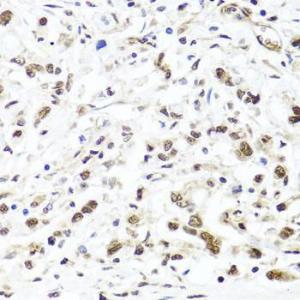 Immunohistochemistry analysis of paraffin-embedded human gastric cancer using Anti-HIRA / HIR Antibody (A12259) at a dilution of 1:100 (40x lens). Perform microwave antigen retrieval with 10 mM PBS buffer pH 7.2 before commencing with IHC staining protocol