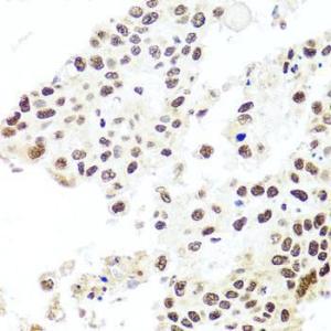 Immunohistochemistry analysis of paraffin-embedded human lung cancer using Anti-HIRA / HIR Antibody (A12259) at a dilution of 1:100 (40x lens). Perform microwave antigen retrieval with 10 mM PBS buffer pH 7.2 before commencing with IHC staining protocol