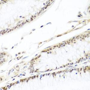 Immunohistochemistry analysis of paraffin-embedded human colon carcinoma tissue using Anti-HIRA / HIR Antibody (A12259) at a dilution of 1:100 (40x lens)