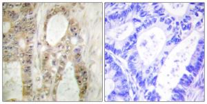 Immunohistochemical analysis of paraffin-embedded human colon carcinoma using Anti-Chk1 Antibody. The right hand panel represents a negative control, where the Antibody was pre-incubated with the immunising peptide