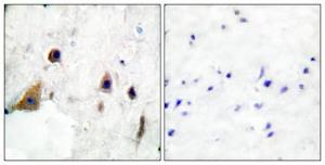 Immunohistochemical analysis of paraffin-embedded human breast cancer using Anti-DARPP-32 (phospho Thr75) Antibody 1:100 (4°C overnight). The right hand panel represents a negative control, where the antibody was pre-incubated with the immunising peptide