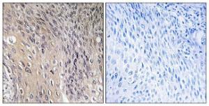 Immunohistochemical analysis of paraffin-embedded human cervix carcinoma using Anti-ARHGDIA (phospho Ser174) Antibody. The right hand panel represents a negative control, where the antibody was pre-incubated with the immunising peptide.