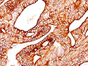 Immunohistochemical analysis of formalin-fixed, paraffin-embedded human colon carcinoma using Anti-Cytokeratin 8 Antibody [TS1]