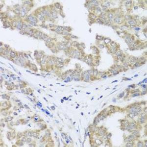 Immunohistochemistry analysis of paraffin-embedded human liver cancer using Anti-TIMM10B Antibody (A12264) at a dilution of 1:100 (40x lens)