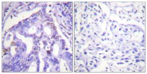 Immunohistochemical analysis of paraffin-embedded human lung carcinoma tissue using Anti-PIAS4 Antibody. The right hand panel represents a negative control, where the antibody was pre-incubated with the immunising peptide.