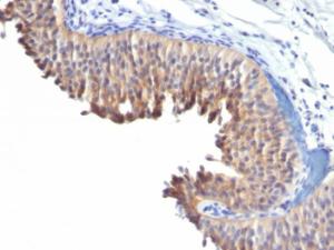 Immunohistochemical analysis of formalin-fixed, paraffin-embedded human bladder carcinoma using Anti-Cytokeratin 10 Antibody [LH2]