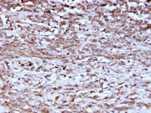 Immunohistochemical analysis of formalin-fixed, paraffin-embedded human hepatocellular carcinoma using Anti-Cathepsin K Antibody [CTSK/2793]