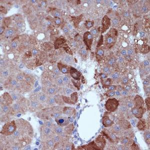 Immunohistochemistry analysis of paraffin-embedded human liver cancer using Anti-Cyclin B2 / CCNB2 Antibody [ARC1435] (A306931) at a dilution of 1:100 (40x lens)