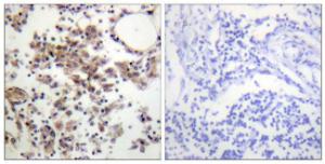 Immunohistochemical analysis of paraffin-embedded human lymph node using Anti-SYK (phospho Tyr323) Antibody. The right hand panel represents a negative control, where the antibody was pre-incubated with the immunising peptide.