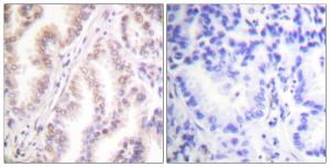 Immunohistochemical analysis of paraffin-embedded human lung carcinoma tissue using Anti-PIAS1 Antibody. The right hand panel represents a negative control, where the Antibody was pre-incubated with the immunising peptide