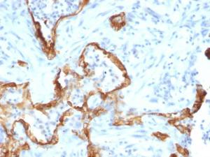 Immunohistochemical analysis of formalin-fixed, paraffin-embedded human lung carcinoma using Anti-Cytokeratin 8 Antibody [SPM192]