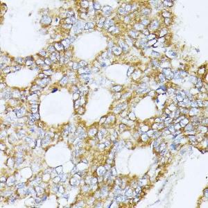 Immunohistochemistry analysis of paraffin-embedded human colon carcinoma tissue using Anti-Complex IV Antibody (A308092) at a dilution of 1:100 (40x lens). Perform microwave antigen retrieval with 10 mM PBS buffer pH 7.2 before commencing with IHC staining protocol.