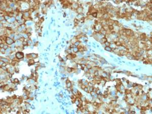 Immunohistochemical analysis of formalin-fixed, paraffin-embedded human melanoma using Anti-Melanoma gp100 Antibody [PMEL/2038]