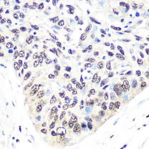 Immunohistochemistry analysis of paraffin-embedded human esophageal cancer using Anti-Exportin-5 Antibody [ARC0838] (A306939) at a dilution of 1:100 (40X lens). Perform microwave antigen retrieval with 10 mM PBS buffer pH 7.2 before commencing with IHC staining protocol