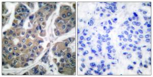 Immunohistochemical analysis of paraffin-embedded human breast carcinoma using Anti-eEF2 (phospho Thr56) Antibody. The right hand panel represents a negative control, where the antibody was pre-incubated with the immunising peptide